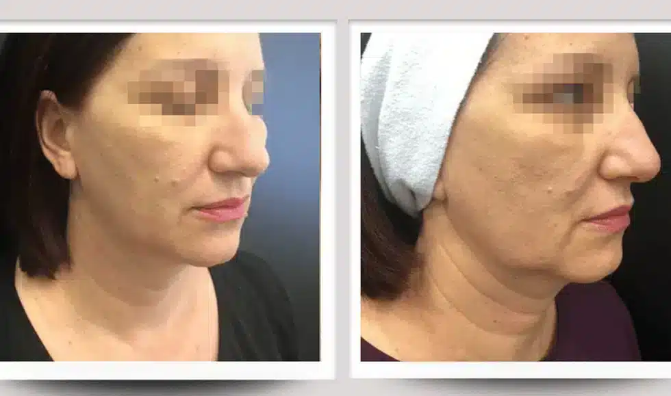 Résultat rajeunissement du visage — avant / après