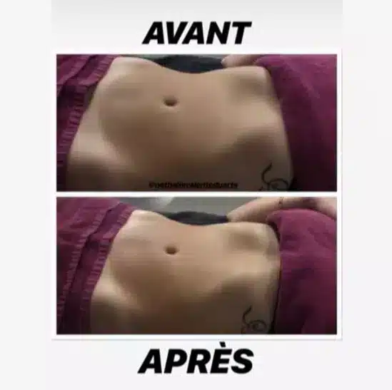 Résultat perte de poids — avant / après