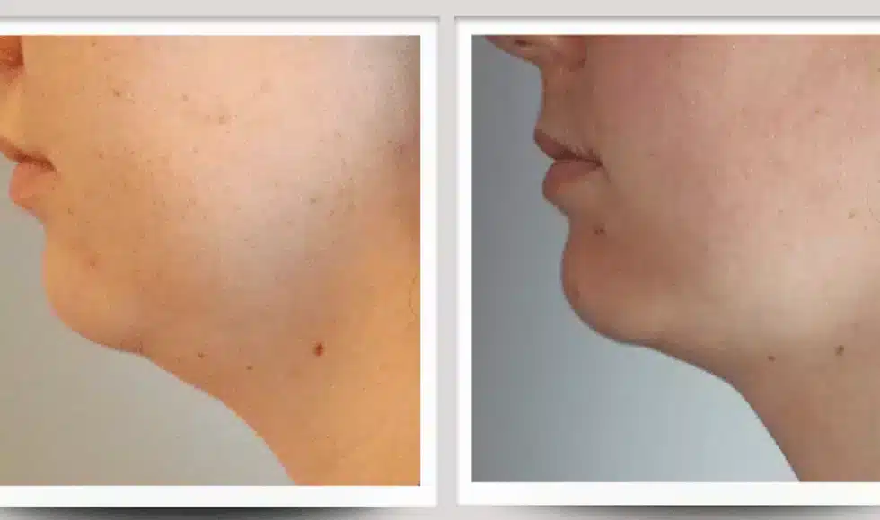 Résultat rajeunissement du visage — avant / après