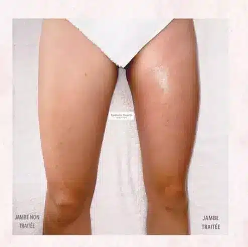 Drainage lymphatique Renata França