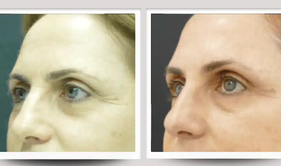 Résultat rajeunissement du visage — avant / après