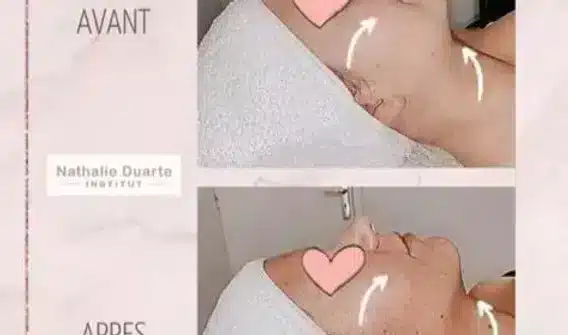 Résultat rajeunissement du visage — avant / après