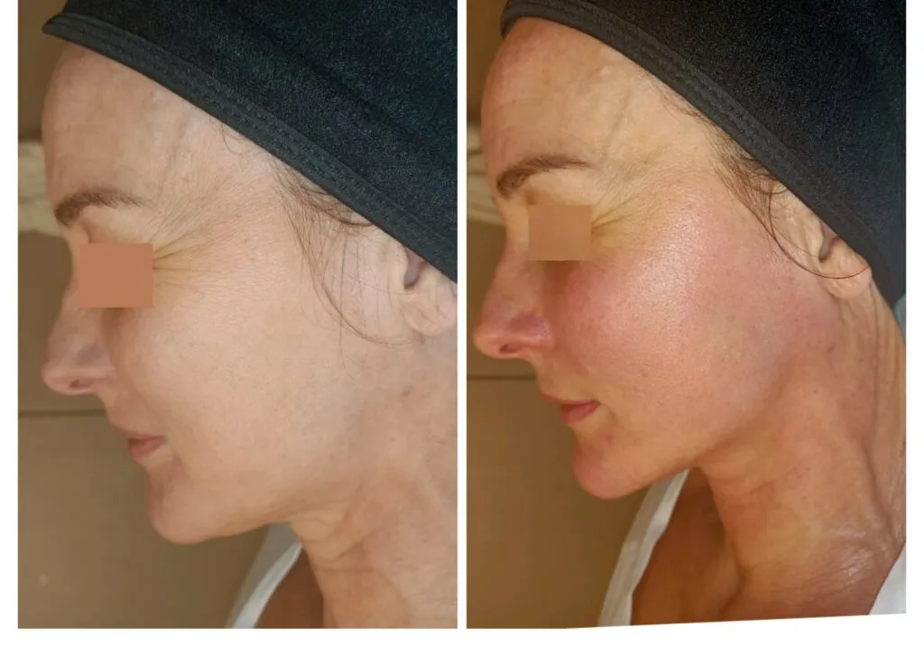 Résultat Miracle Face — avant / après