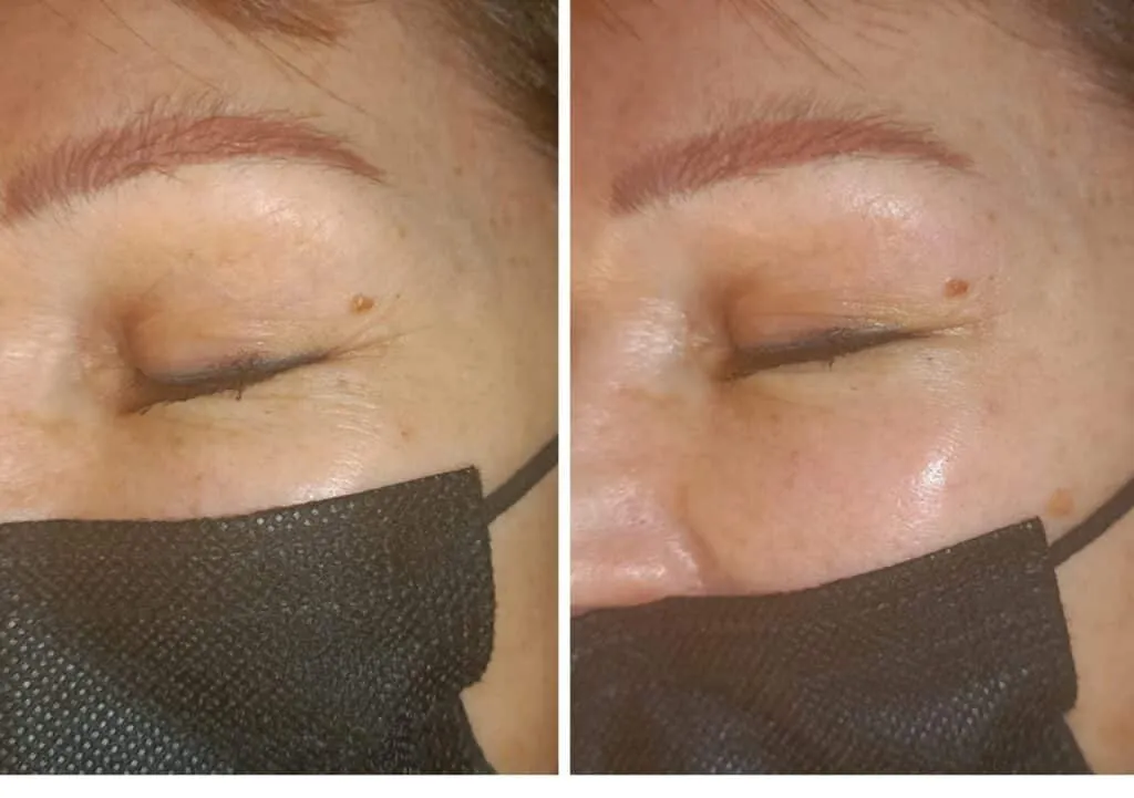 Résultat radiofréquence contour des yeux — avant / après