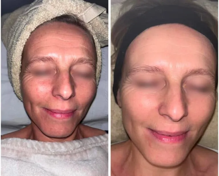 Rajeunissement du visage — avant / après