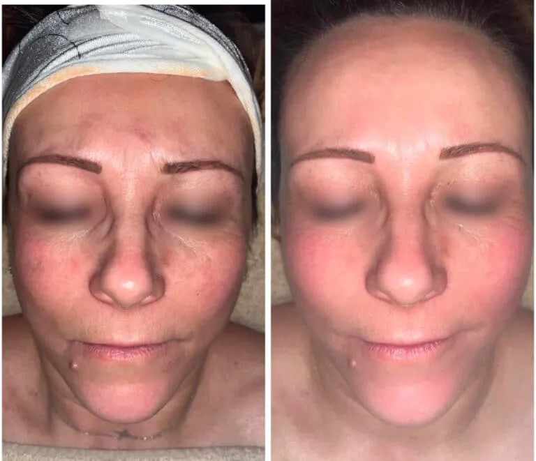 Rajeunissement du visage — avant / après